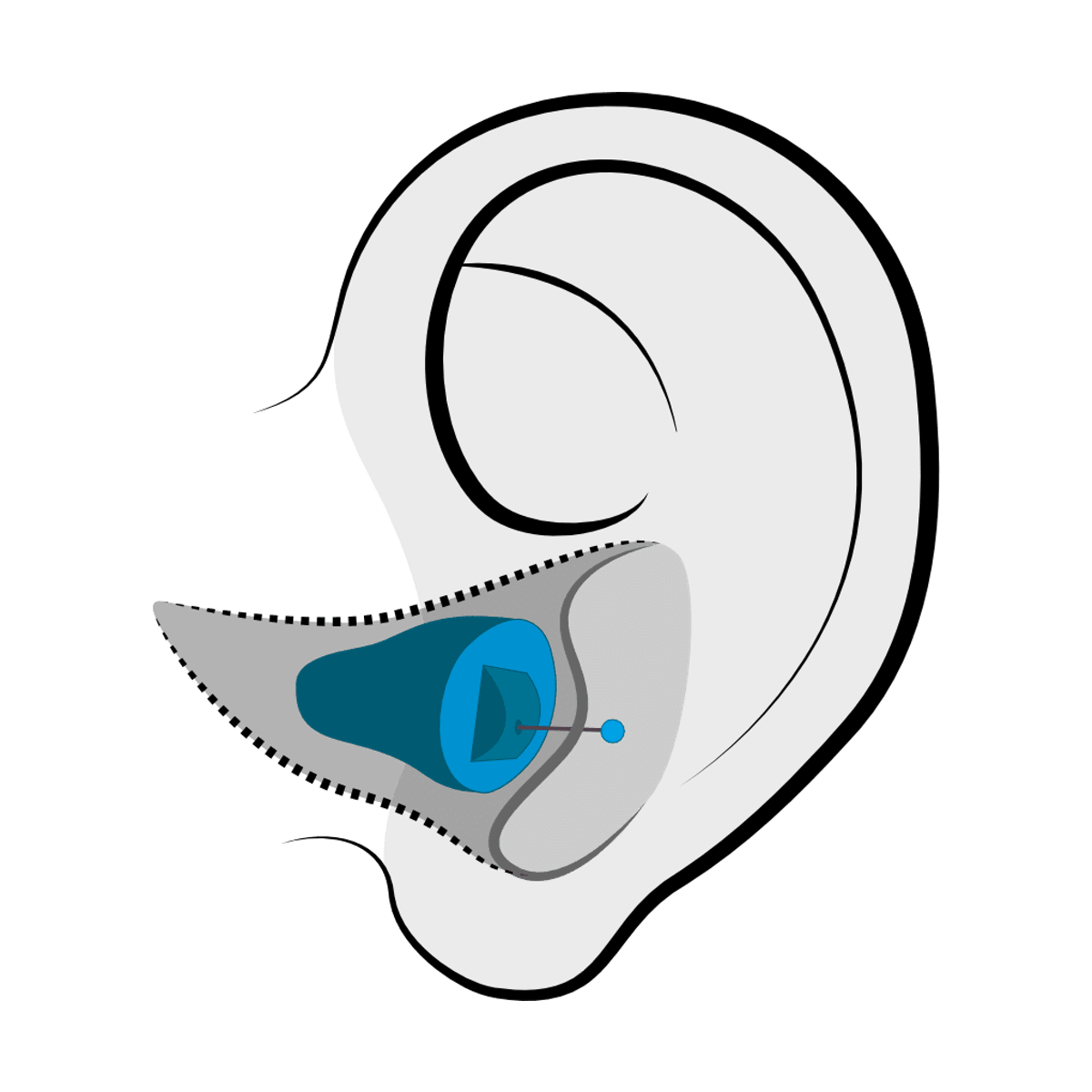Invisible-in-Canal (IIC) hearing aid style fitted at Precision Hearing in San Antonio, TX